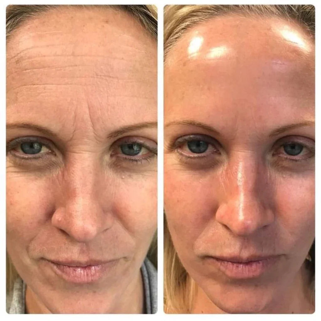 Lires® Retinal Shot - Adiós Arrugas