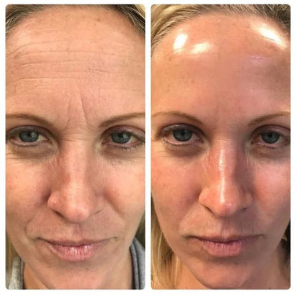 Lires® Retinal Shot - Adiós Arrugas